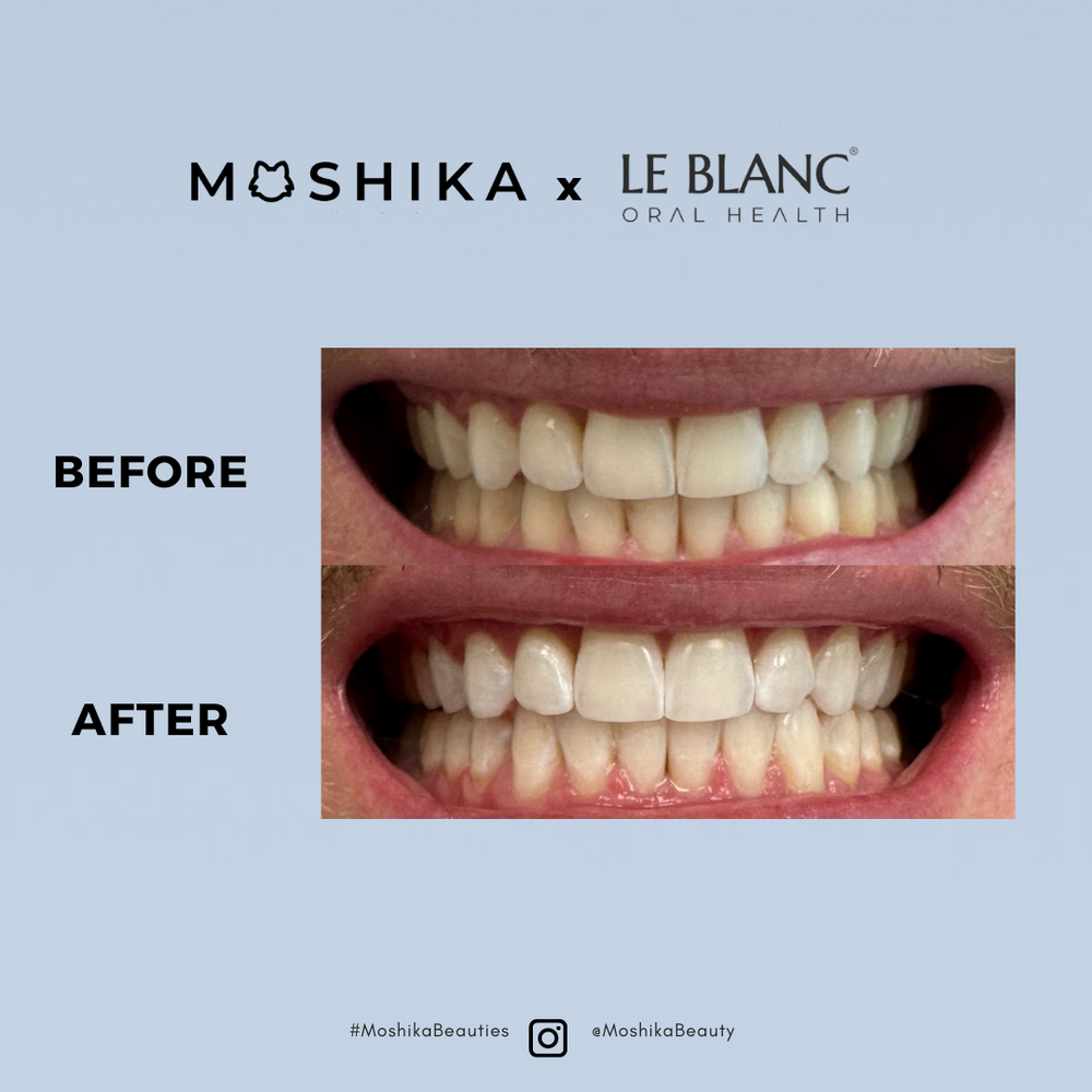 Moshika X LE BLANC Teeth Whitening Kit | Vegan At-Home Whitening