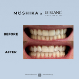 Moshika X LE BLANC Teeth Whitening Kit